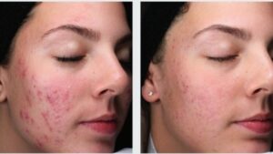 Chirurgia Plastica Frenello | VISIA: Imaging ed analisi del viso