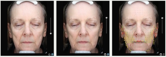 Chirurgia Plastica Frenello | VISIA: Imaging ed analisi del viso