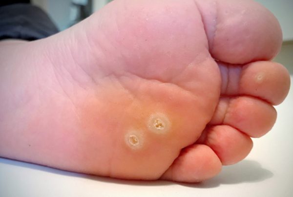Chirurgia Plastica Frenello|Verruche