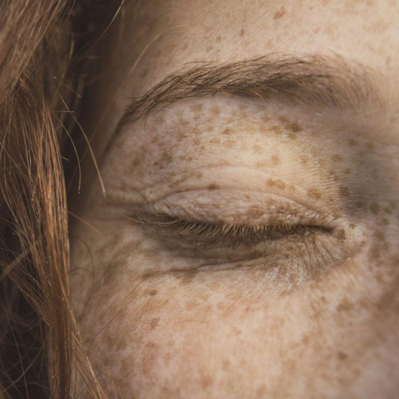 Ipl Laser Q-Switched Per Macchie E Melasma